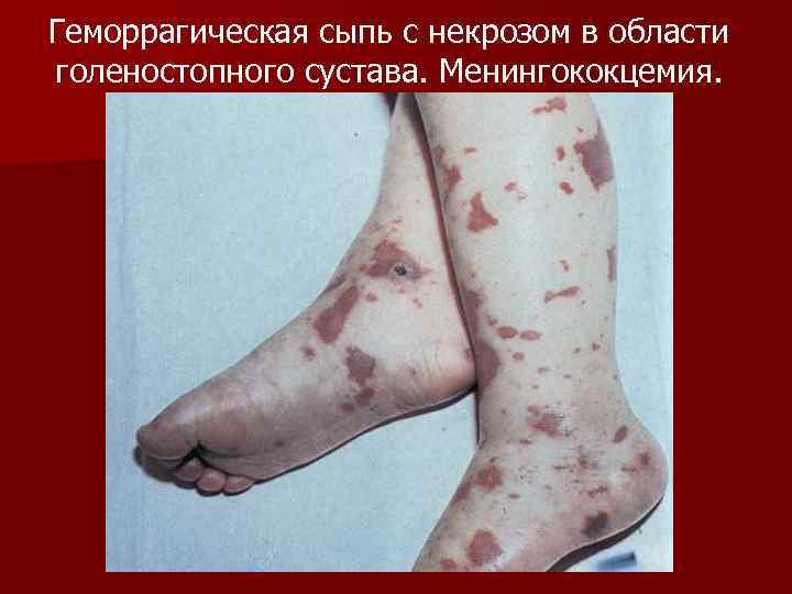 Геморрагическая сыпь с некрозом в области голеностопного сустава. Менингококцемия. 
