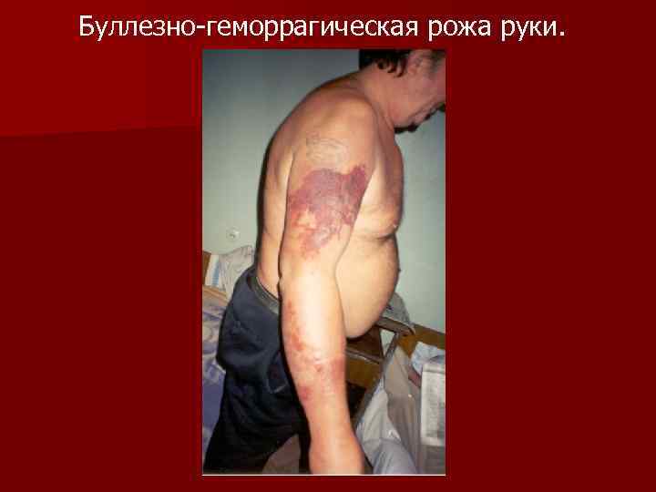 Буллезно-геморрагическая рожа руки. 