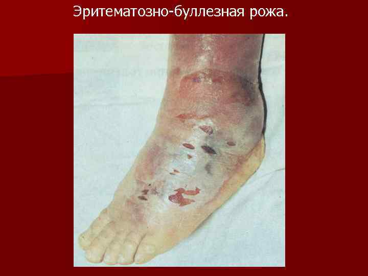 Эритематозно-буллезная рожа. 