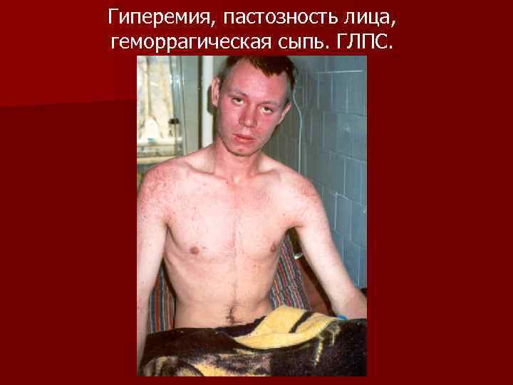 Гиперемия, пастозность лица, геморрагическая сыпь. ГЛПС. 