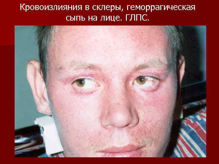 Кровоизлияния в склеры, геморрагическая сыпь на лице. ГЛПС. 