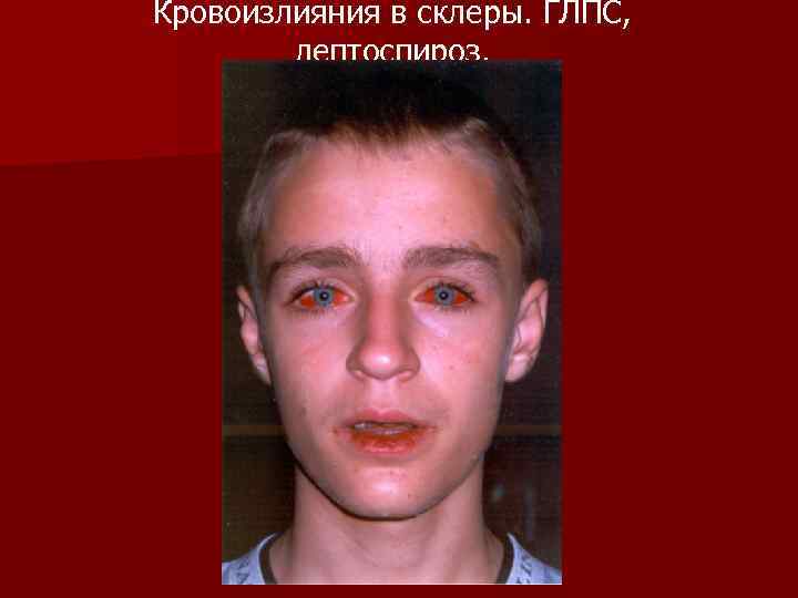 Кровоизлияния в склеры. ГЛПС, лептоспироз. 