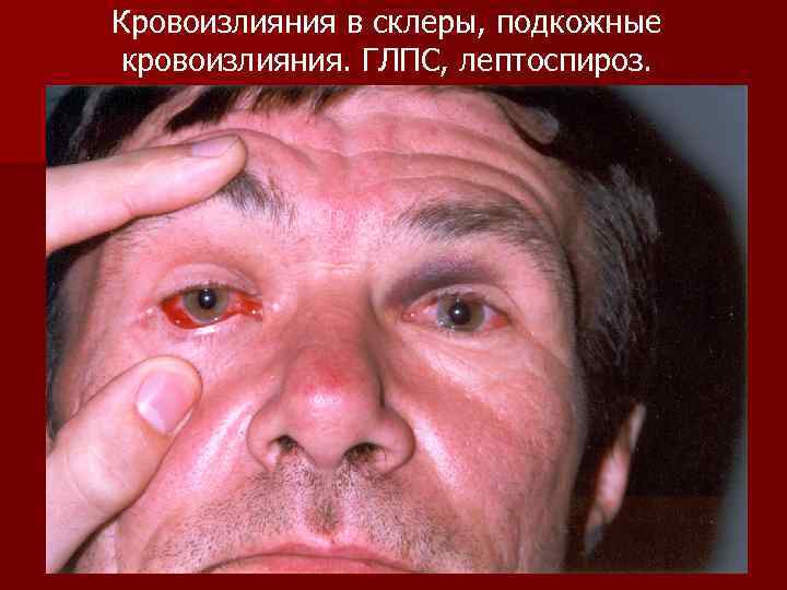 Кровоизлияния в склеры, подкожные кровоизлияния. ГЛПС, лептоспироз. 