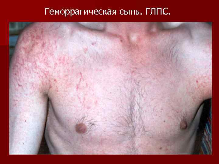 Геморрагическая сыпь. ГЛПС. 