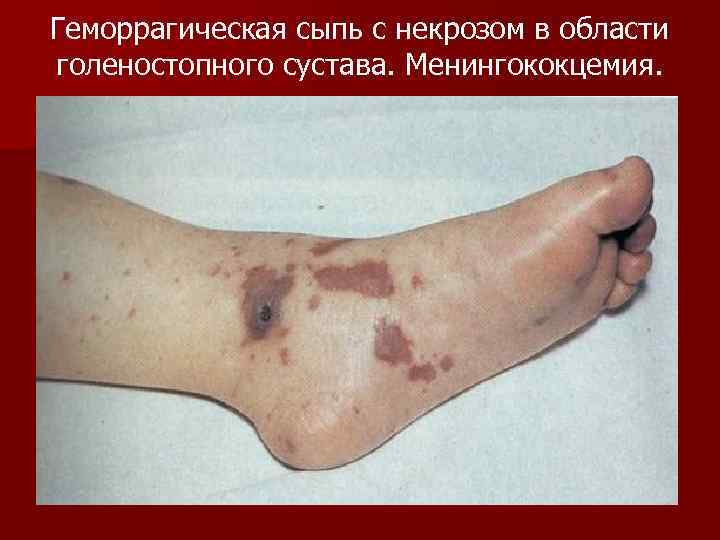 Геморрагическая сыпь с некрозом в области голеностопного сустава. Менингококцемия. 