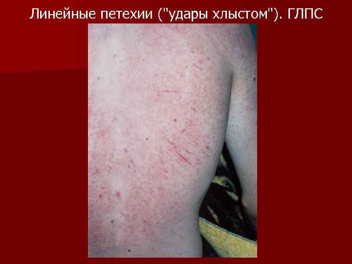 Линейные петехии ("удары хлыстом"). ГЛПС 