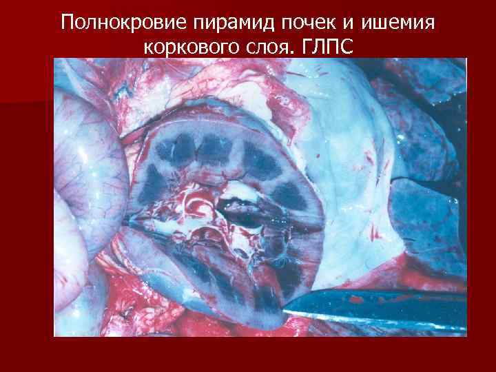 Полнокровие пирамид почек и ишемия коркового слоя. ГЛПС 