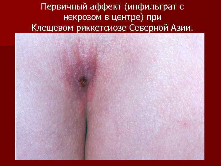 Первичный аффект (инфильтрат с некрозом в центре) при Клещевом риккетсиозе Северной Азии. 