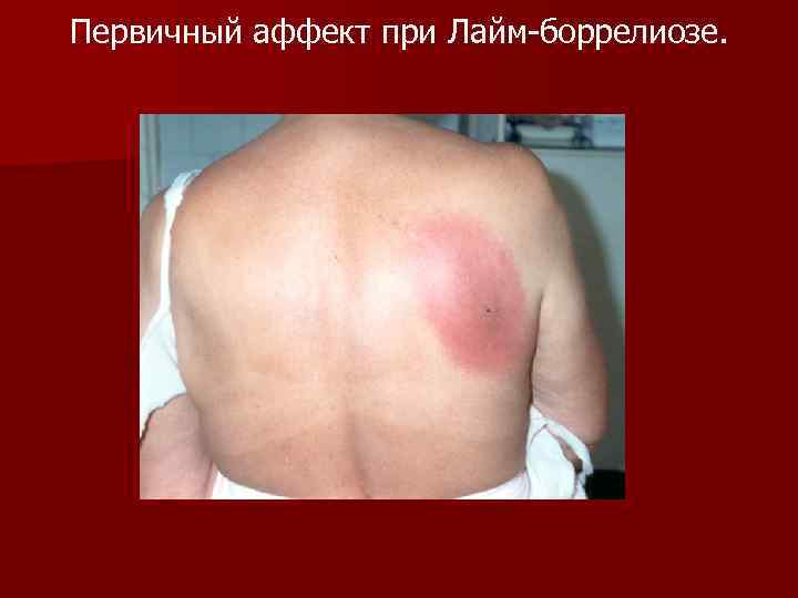 Первичный аффект при Лайм-боррелиозе. 