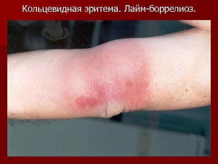 Кольцевидная эритема. Лайм-боррелиоз. 
