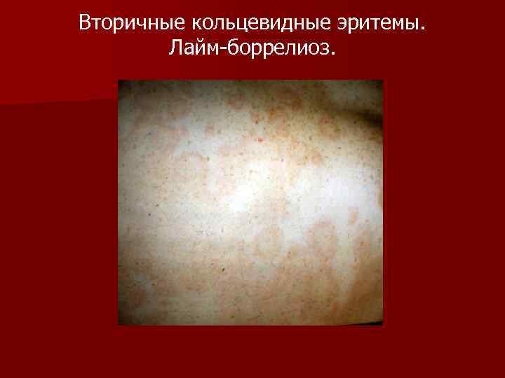 Вторичные кольцевидные эритемы. Лайм-боррелиоз. 