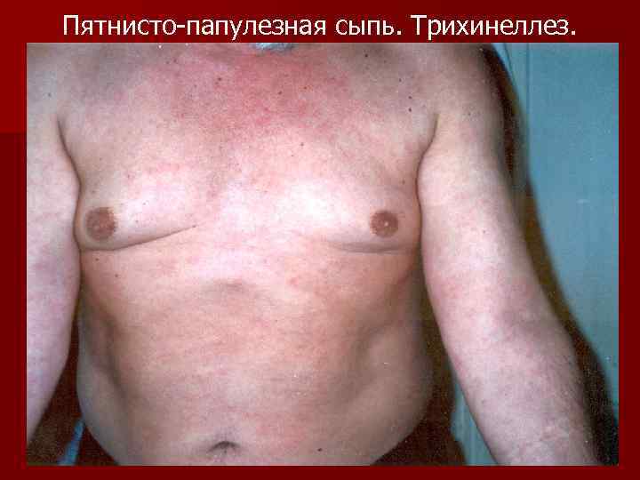Пятнисто-папулезная сыпь. Трихинеллез. 