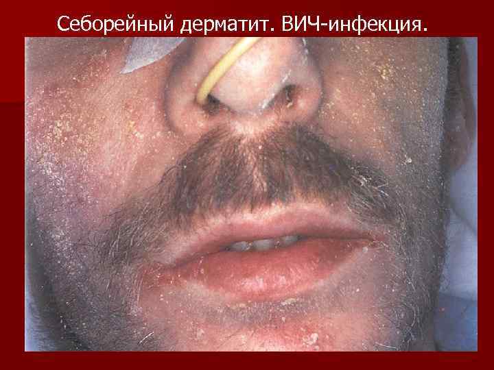 Себорейный дерматит. ВИЧ-инфекция. 