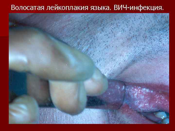 Волосатая лейкоплакия языка. ВИЧ-инфекция. 