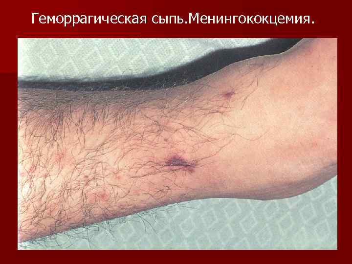 Геморрагическая сыпь. Менингококцемия. 