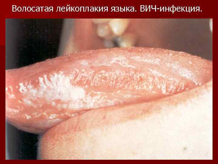 Волосатая лейкоплакия языка. ВИЧ-инфекция. 