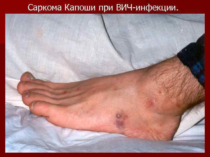 Саркома Капоши при ВИЧ-инфекции. 