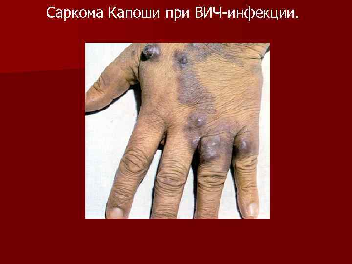 Саркома Капоши при ВИЧ-инфекции. 