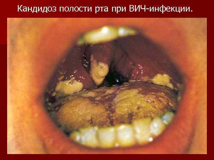 Кандидоз полости рта при ВИЧ-инфекции. 