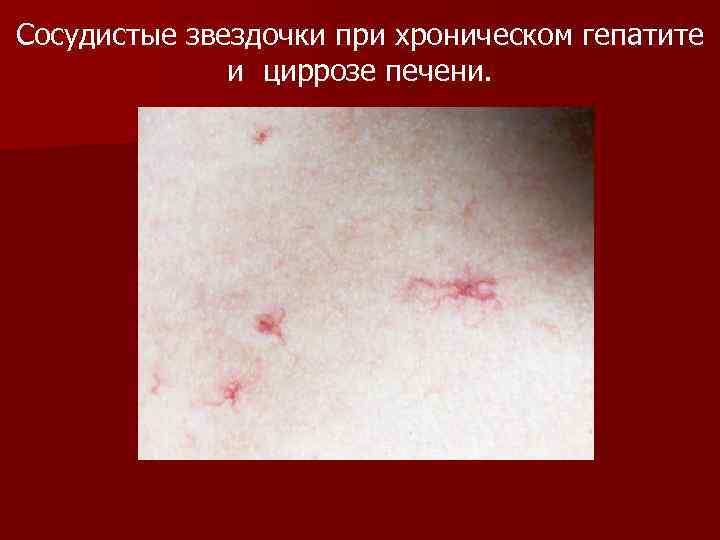 Сосудистые звездочки при хроническом гепатите и циррозе печени. 