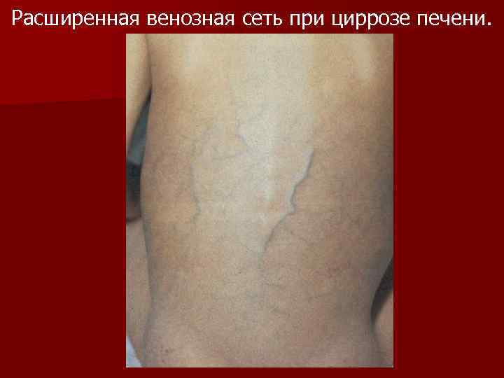 Расширенная венозная сеть при циррозе печени. 