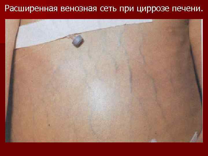 Расширенная венозная сеть при циррозе печени. 