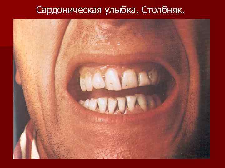 Сардоническая улыбка. Столбняк. 