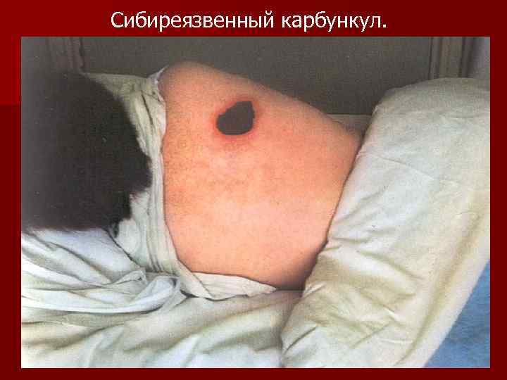 Сибиреязвенный карбункул. 