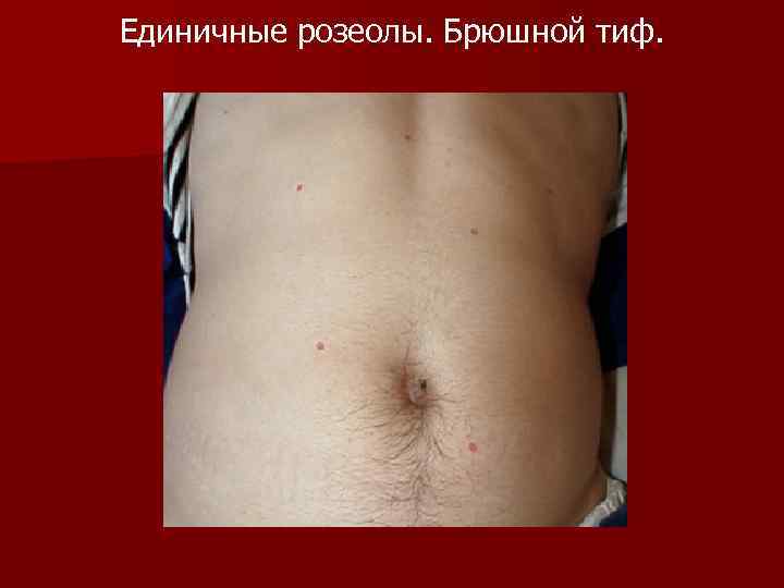 Единичные розеолы. Брюшной тиф. 