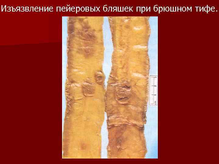 Изъязвление пейеровых бляшек при брюшном тифе. 