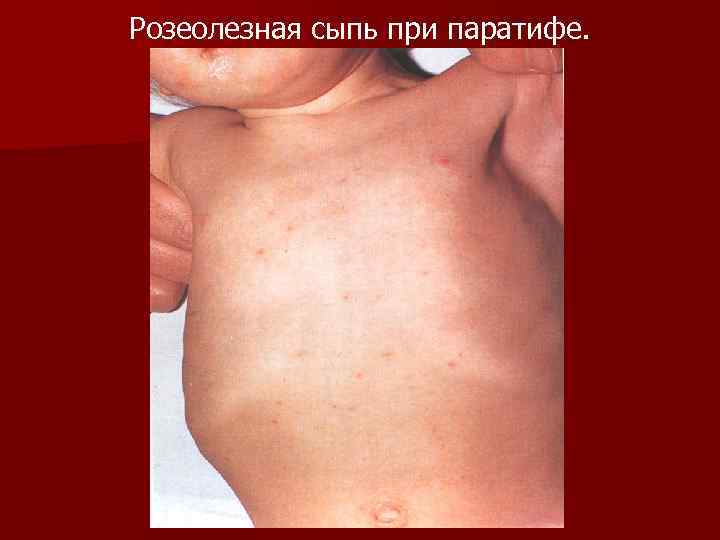 Розеолезная сыпь при паратифе. 