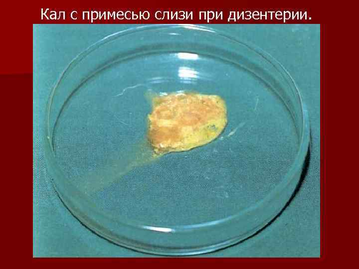 Кал с примесью слизи при дизентерии. 