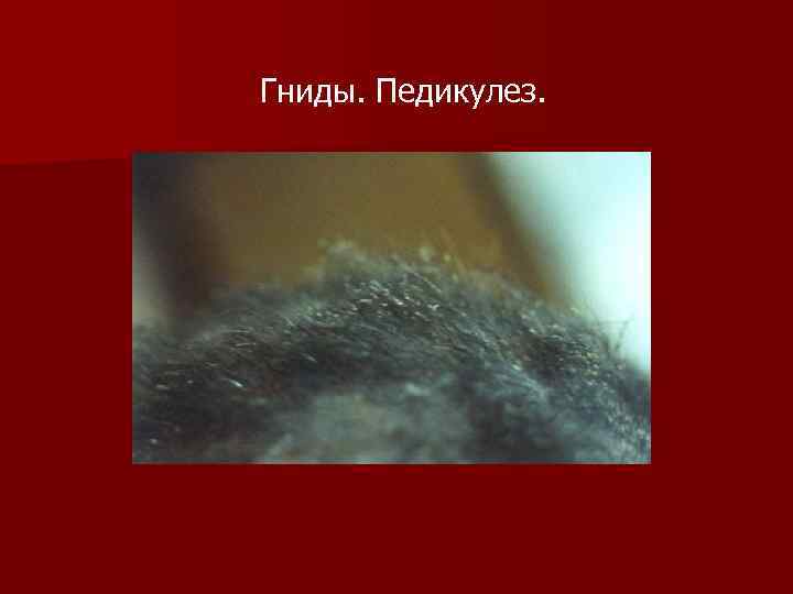 Гниды. Педикулез. 