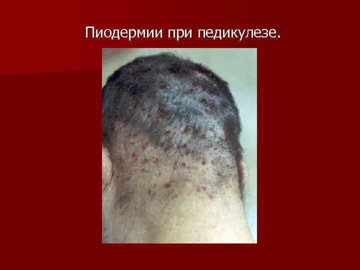 Пиодермии при педикулезе. 