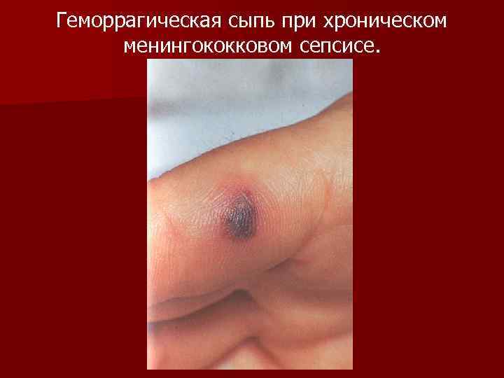 Геморрагическая сыпь при хроническом менингококковом сепсисе. 