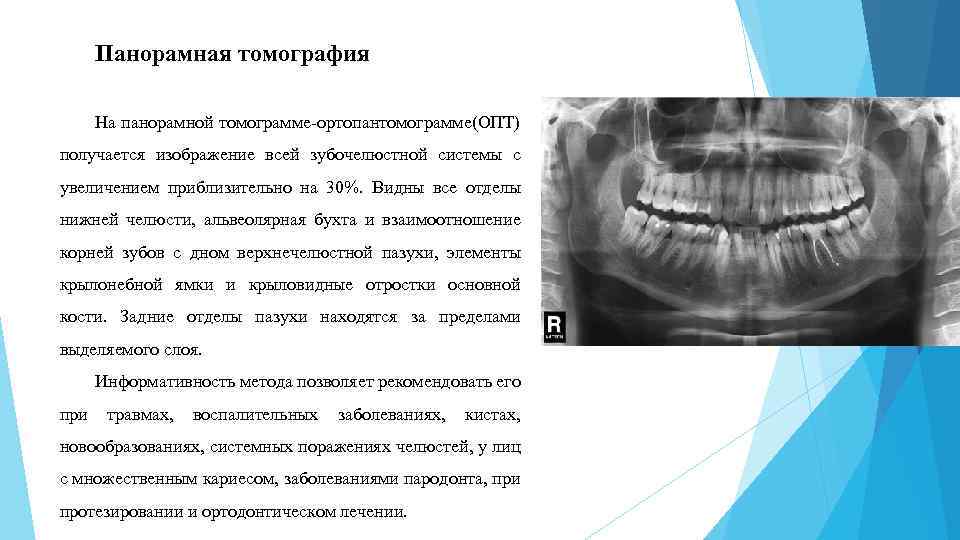 Вариант зонографии позволяющий получить развернутое плоскостное изображение челюстей