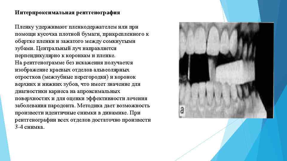 Снимок определение. Интерпроксимальная рентгенография зубов техника. Описание кариеса на рентгене. Описание рентгенограммы зуба при кариесе. Рентген кариеса зуба описание.