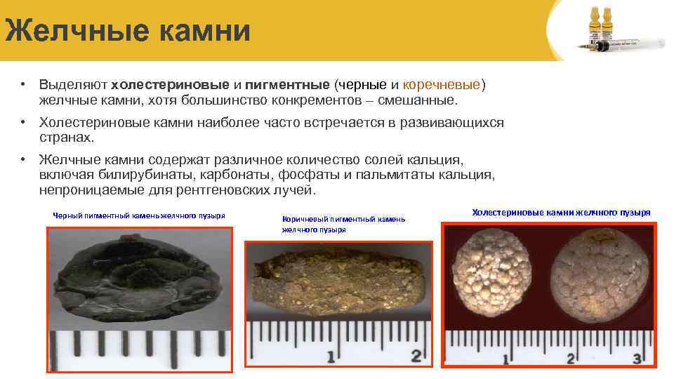Желчные камни • Выделяют холестериновые и пигментные (черные и коречневые) желчные камни, хотя большинство