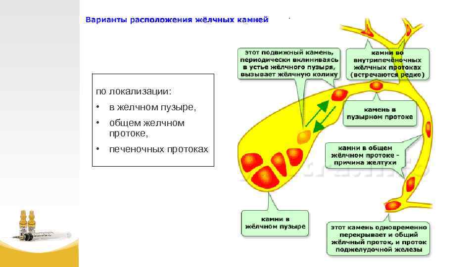 по локализации: • в желчном пузыре, • общем желчном протоке, • печеночных протоках 