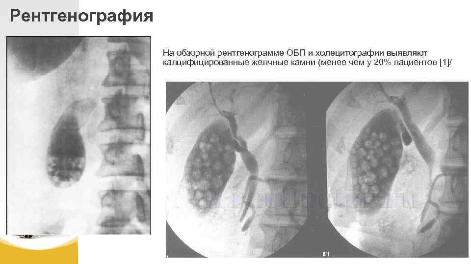 Рентгенография На обзорной рентгенограмме ОБП и холецитографии выявляют калцифицированные желчные камни (менее чем у