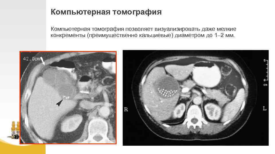 Компьютерная томография позволяет визуализировать даже мелкие конкременты (преимущественно кальциевые) диаметром до 1– 2 мм.