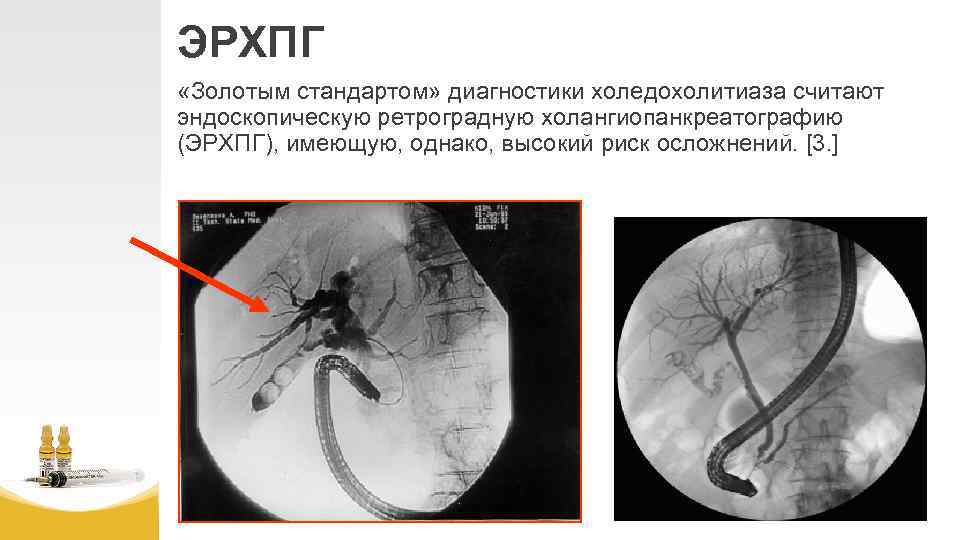 ЭРХПГ «Золотым стандартом» диагностики холедохолитиаза считают эндоскопическую ретроградную холангиопанкреатографию (ЭРХПГ), имеющую, однако, высокий риск