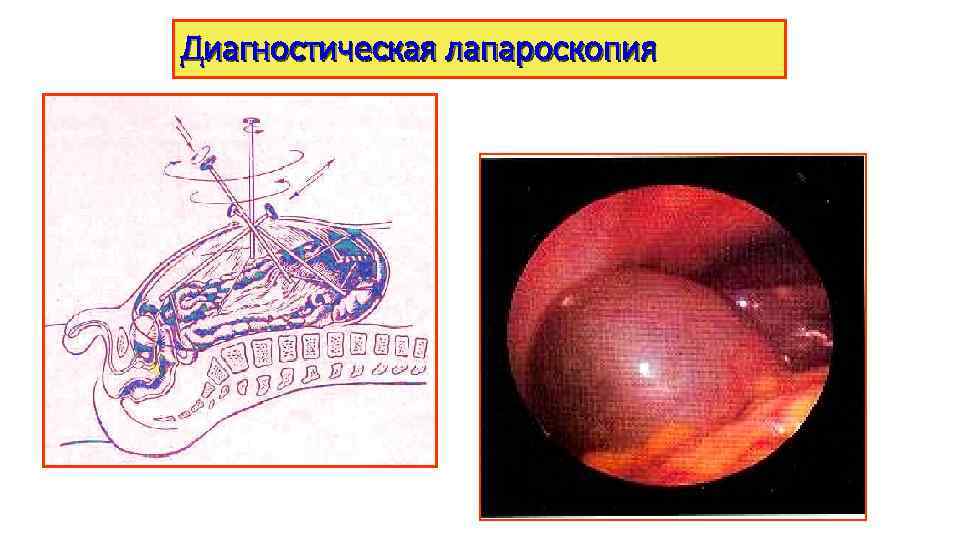 Диагностическая лапароскопия 