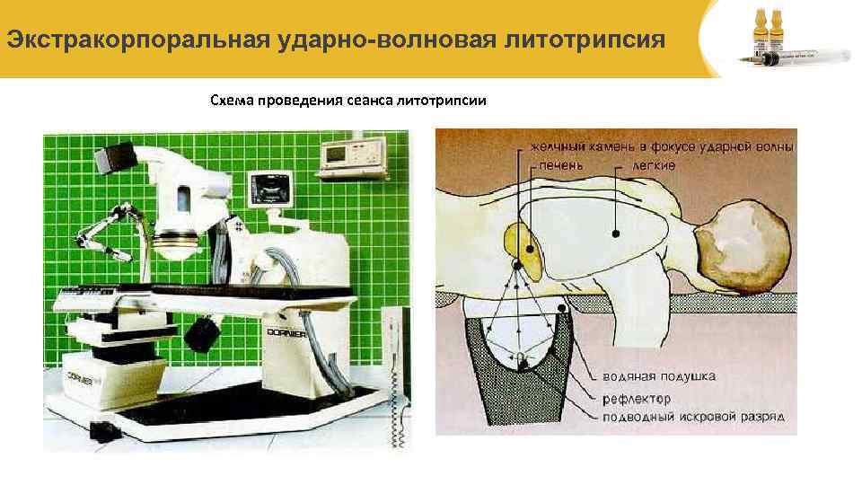 Экстракорпоральная ударно-волновая литотрипсия Схема проведения сеанса литотрипсии 
