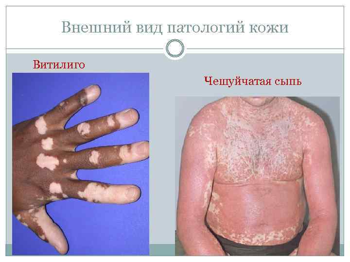 Внешний вид патологий кожи Витилиго Чешуйчатая сыпь 