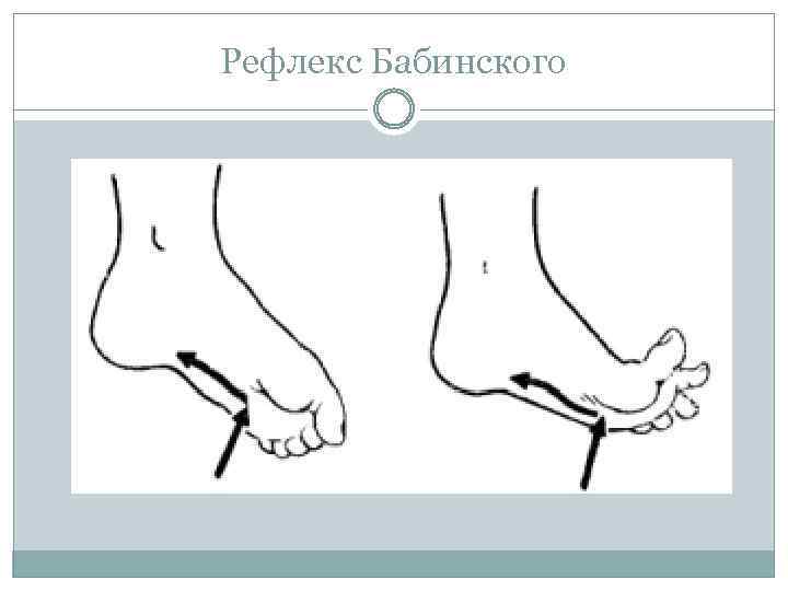 Рефлекс Бабинского 