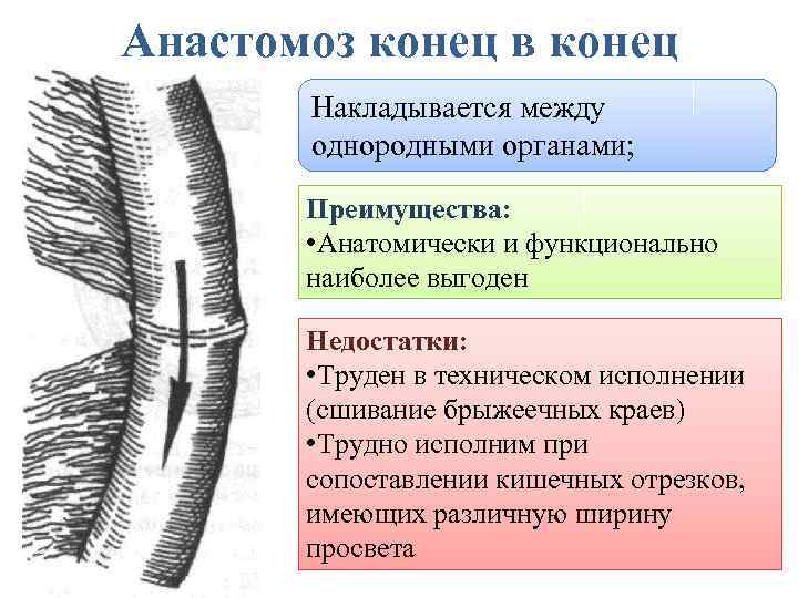 Анастомоз конец в конец Накладывается между однородными органами; Преимущества: • Анатомически и функционально наиболее