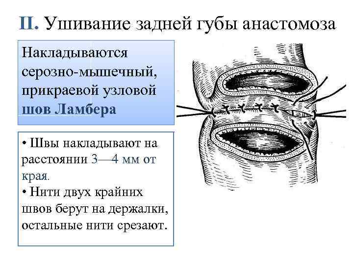 II. Ушивание задней губы анастомоза Накладываются серозно-мышечный, прикраевой узловой шов Ламбера • Швы накладывают