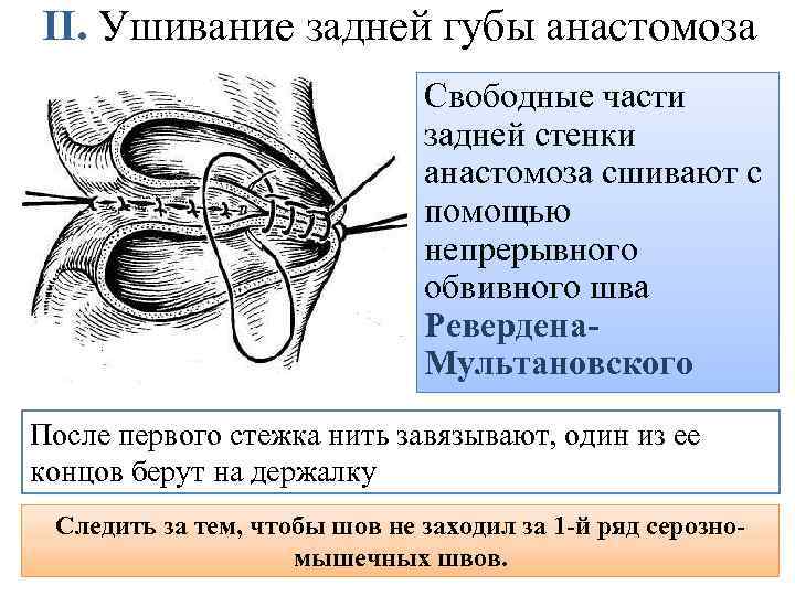 II. Ушивание задней губы анастомоза Свободные части задней стенки анастомоза сшивают с помощью непрерывного