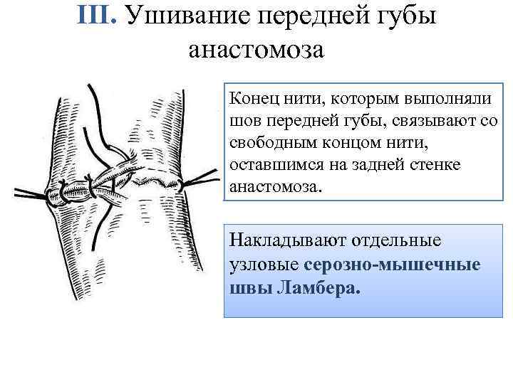 III. Ушивание передней губы анастомоза Конец нити, которым выполняли шов передней губы, связывают со